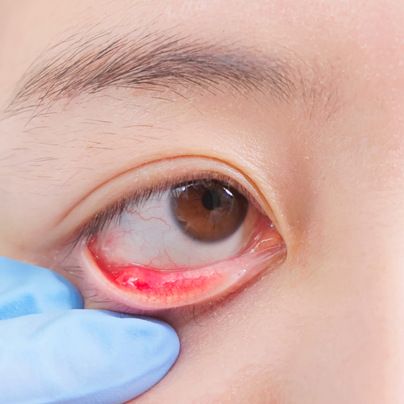 結膜炎・アレルギー・ものもらい